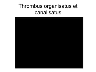 Thrombus organisatus et
canalisatus

 