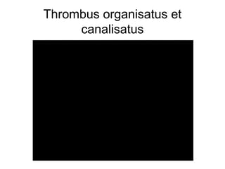 Thrombus organisatus et
canalisatus

 