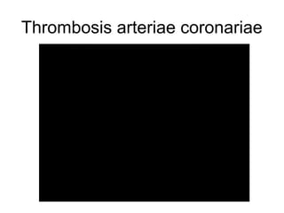 Thrombosis arteriae coronariae

 