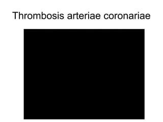 Thrombosis arteriae coronariae

 