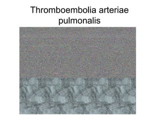 Thromboembolia arteriae
pulmonalis

 