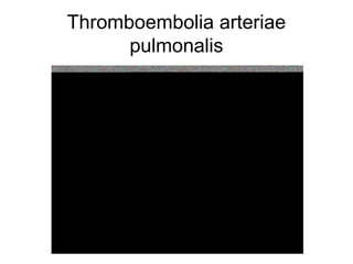 Thromboembolia arteriae
pulmonalis

 