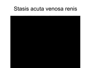 Stasis acuta venosa renis

 