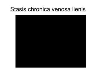 Stasis chronica venosa lienis

 