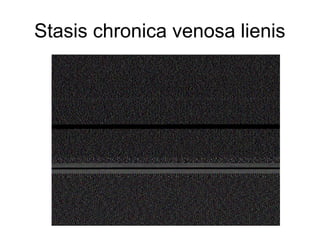 Stasis chronica venosa lienis

 