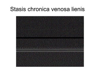 Stasis chronica venosa lienis

 