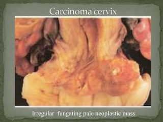 Irregular fungating pale neoplastic mass
 