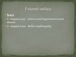  Scars
 V- shaped scars- infarcts and hypertensive renal
disease
 U- shaped scars- Reflux nephropathy
 