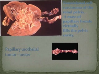 Transitional cell
carcinoma of the
renal pelvis.
A mass of
papillary fronds
virtually
fills the pelvic
cavity.
 