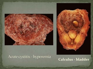 Calculus - bladder
 