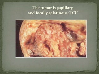 The tumor is papillary
and focally gelatinous:TCC
 