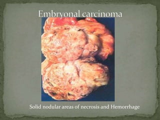 Solid nodular areas of necrosis and Hemorrhage
 