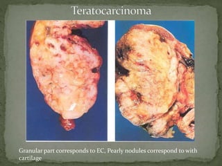 Granular part corresponds to EC, Pearly nodules correspond to with
cartilage
 