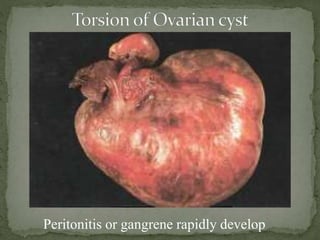 Peritonitis or gangrene rapidly develop
 