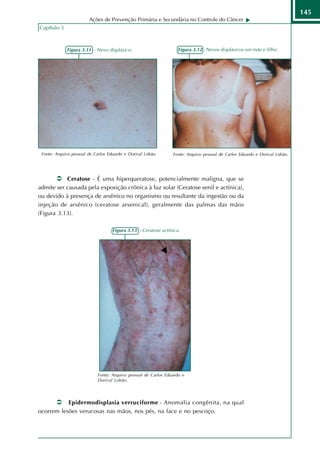 145
                        Ações de Prevenção Primária e Secundária no Controle do Câncer
Capítulo 3



             Figura 3.11 - Nevo displásico.                        Figura 3.12 - Nevos displásicos em mãe e filho.




 Fonte: Arquivo pessoal de Carlos Eduardo e Dorival Lobão.      Fonte: Arquivo pessoal de Carlos Eduardo e Dorival Lobão.




           Ceratose - É uma hiperqueratose, potencialmente maligna, que se
admite ser causada pela exposição crônica à luz solar (Ceratose senil e actínica),
ou devido à presença de arsênico no organismo ou resultante da ingestão ou da
injeção de arsênico (ceratose arsenical), geralmente das palmas das mãos
(Figura 3.13).

                                    Figura 3.13 - Ceratose actínica.




                            Fonte: Arquivo pessoal de Carlos Eduardo e
                            Dorival Lobão.




           Epidermodisplasia verruciforme - Anomalia congênita, na qual
ocorrem lesões verucosas nas mãos, nos pés, na face e no pescoço.
 