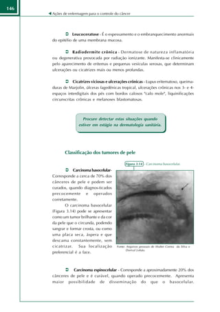146
      Ações de enfermagem para o controle do câncer




                  Leucoceratose - É o espessamento e o embranquecimento anormais
      do epitélio de uma membrana mucosa.

                 Radiodermite crônica - Dermatose de natureza inflamatória
      ou degenerativa provocada por radiação ionizante. Manifesta-se clinicamente
      pelo aparecimento de eritemas e pequenas vesículas serosas, que determinam
      ulcerações ou cicatrizes mais ou menos profundas.

                  Cicatrizes viciosas e ulcerações crônicas - Lupus eritematoso, queima-
      duras de Marjolin, úlceras fagedênicas tropical, ulcerações crônicas nos 3- e 4-
      espaços interdigitais dos pés com bordos calosos "calo mole", liquinificações
      circunscritas crônicas e melanoses blastomatosas.



                       Procure detectar estas situações quando
                     estiver em estágio na dermatologia sanitária.




             Classificação dos tumores de pele

                                                 Figura 3.14 - Carcinoma basocelular.
                  Carcinoma basocelular-
      Corresponde a cerca de 70% dos
      cânceres de pele e podem ser
      curados, quando diagnos-ticados
      precocemente e operados
      corretamente.
             O carcinoma basocelular
      (Figura 3.14) pode se apresentar
      como um tumor brilhante e da cor
      da pele que o circunda, podendo
      sangrar e formar crosta, ou como
      uma placa seca, áspera e que
      descama constantemente, sem
      cicatrizar.    Sua localização       Fonte: Arquivos pessoais de Walter Correa da Silva e
                                                  Dorival Lobão.
      preferencial é a face.



                Carcinoma espinocelular - Corresponde a aproximadamente 20% dos
      cânceres de pele e é curável, quando operado precocemente. Apresenta
      maior possibilidade de disseminação do que o basocelular.
 