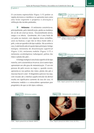 147
                          Ações de Prevenção Primária e Secundária no Controle do Câncer
Capítulo 3



O carcinoma espinocelular (Figura 3.15) prefere as                       Figura 3.15 - Carcinoma espinocelular
                                                                                       de lábio inferior.
regiões do tronco e membros e se apresenta mais como
uma lesão vegetante e propensa à ulceração e
infiltração dos tecidos profundos.


                 Melanoma - O melanoma caracteriza-se,
principalmente, pela intensificação, perda ou mudança
de cor de um sinal ou nevos. Ocasionalmente ulcera,
sangra e se infecta. Geralmente, ele é uma lesão de
                                                                      Fontes: Arquivos pessoais de Walter Correia
cor preta ou marrom, com algumas áreas vermelhas,                             da Silva e Dorival Lobão.
azuis ou brancas, e que não se eleva muito sobre a
pele, a não ser quando é do tipo nodular. De ocorrência
rara, é subclassificada em quatro tipos principais: lentigo
maligno; melanoma de disseminação superficial
(Figura 3.16); melanoma nodular (Figura 3.17) e
melanoma acrolentiginoso (subungueal, palmas das                         Figura 3.16 -Melanoma de disseminação
                                                                                      superficial.
mãos e planta dos pés) .
         O lentigo maligno é uma lesão superficial do tipo
mancha, sem características invasivas. Já os outros tipos
apresentam um alto grau de metastatização. É raro em
pessoas de pele escura ou negra e, quando ocorre,
apresenta-se nas palmas das mãos, planta dos pés e
mucosas bucal e anal. O diagnóstico precoce (ou seja,
com invasão até a interface papilo-reticular da derma)
resulta em significativo aumento da taxa de cura. O
                                                                      Fonte: Arquivo pessoal de Luiz Eduardo Atalécio.
melanoma nodular e o extracutâneo apresentam pior
prognóstico do que os três tipos cutâneos.




        Figura 3.17 - Melanoma nodular.                        Figura 3.18 - Melanoma de cavidade oral.




Fonte: Arquivo pessoal de Luiz Eduardo Atalécio.          Fonte: Arquivo pessoal de Walter Correa da Silva.
 