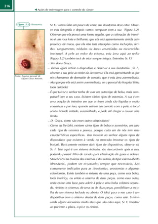 216
                            Ações de enfermagem para o controle do câncer




        Figura 5.2 - Ileostomia.         Sr. F., vamos falar um pouco de como sua ileostomia deve estar. Obser-
                                         ve esta fotografia e depois vamos comparar com a sua (Figura 5.2).
                                         Observe que ela possui uma forma regular, que a coloração do intesti-
                                         no é um rosa forte e brilhante, que ela está aparentemente úmida com
                                         presença de muco, que ela não tem alterações como inchações, feri-
                                         das, sangramento, nódulos ou áreas amareladas ou escurecidas
                                         (necrose). A pele ao redor do estoma, esta área aqui ao redor
                                         (Figura 5.2) também terá de estar sempre íntegra. Entendeu Sr. F.?
                                        Sim dona Graça.
                                        Vamos agora retirar o dispositivo e observar a sua ileostomia. Sr. F.,
                                         observe a sua pele ao redor da ileostomia. Ela está apresentando o que
      Fonte: Arquivo pessoal de
             Edjane Farias Amorim.       nós chamamos de dermatite de contato, que é esta área avermelhada.
                                        Mas porque ela está assim avermelhada, se o pessoal do hospital tinha
                                         todo cuidado?
                                        É que talvez o senhor tenha de usar um outro tipo de bolsa, mais com-
                                         patível com o seu caso. Existem vários tipos de ostomias. A sua é em
                                         uma porção do intestino em que as fezes ainda são líquidas e muito
                                         corrosivas e por isso, quando entram em contato com a pele, o local
                                         acaba ficando irritado, avermelhado, e pode até chegar a causar uma
                                         ferida.
                                        D. Graça, como são esses outros dispositivos?
                                        Como eu lhe falei, existem vários tipos de bolsas e acessórios, um para
                                         cada tipo de ostomia e pessoa, porque cada um de nós tem suas
                                         características específicas. Vou mostrar ao senhor alguns tipos de
                                         dispositivos que existem à venda no mercado (mostrar os tipos de
                                         bolsas). Basicamente existem dois tipos de dispositivos, observe só,
                                         Sr. F. Este aqui é um sistema fechado, são descartáveis após o uso,
                                         podendo possuir filtro de carvão para eliminação de gases e odores.
                                         São eficazes na maioria dos estomas. Estes outros, do tipo sistema aberto
                                         (drenáveis), podem ser esvaziados sempre que necessário. São
                                         comumente indicados para as ileostomias, urostomias e algumas
                                         colostomias. Existe também o sistema de uma peça, como esta bolsa,
                                         toda inteiriça, ou então o sistema de duas peças, como essa outra,
                                         onde existe uma base para aderir à pele e uma bolsa coletora separa-
                                         da. Ambos os sistemas, de uma ou de duas peças, possibilitam a esco-
                                         lha de um sistema fechado ou aberto. O ideal para o seu caso é um
                                         dispositivo com o sistema aberto de duas peças, como este. Existem
                                         ainda alguns acessórios muito úteis que são estes aqui, Sr. F. (mostrar
                                         ao paciente a placa, o pó e os cintos).
 