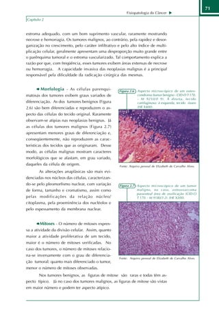 71
                                                          Fisiopatologia do Câncer
Capítulo 2


estroma adequado, com um bom suprimento vascular, raramente mostrando
necrose e hemorragia. Os tumores malignos, ao contrário, pela rapidez e desor-
ganização no crescimento, pelo caráter infiltrativo e pelo alto índice de multi-
plicação celular, geralmente apresentam uma desproporção muito grande entre
o parênquima tumoral e o estroma vascularizado. Tal comportamento explica a
razão por que, com freqüência, esses tumores exibem áreas extensas de necrose
ou hemorragia. A capacidade invasiva das neoplasias malignas é a principal
responsável pela dificuldade da radicação cirúrgica das mesmas.


        Morfologia - As células parenqui-           Figura 2.6 - Aspecto microscópico de um osteo-
matosas dos tumores exibem graus variados de                     condroma (tumor benigno - CID-O T 170.
                                                                 - M 9210/0 9). À direita, tecido
diferenciação. As dos tumores benignos (Figura                   cartilaginoso; à esquerda, tecido ósseo
2.6) são bem diferenciadas e reproduzem o as-                    (HE X400).

pecto das células do tecido original. Raramente
observam-se atipias nas neoplasias benignas. Já
as células dos tumores malignos (Figura 2.7)
apresentam menores graus de diferenciação e,
conseqüentemente, não reproduzem as carac-
terísticas dos tecidos que as originaram. Desse
modo, as células malignas mostram caracteres
morfológicos que se afastam, em grau variado,
daqueles da célula de origem.                        Fonte: Arquivo pessoal de Elizabeth de Carvalho Alves.
       As alterações anaplásicas são mais evi-
denciadas nos núcleos das células, caracterizan-
do-se pelo pleomorfismo nuclear, com variação        Figura 2.7 - Aspecto microscópico de um tumor
de forma, tamanho e cromatismo, assim como                        maligno, no caso, osteossarcoma
                                                                  paraosteal área de ossificação (CID-O
pelas modificações da relação núcleo/                             T 170. - M 9180/3 2). (HE X200).
citoplasma, pela proeminência dos nucléolos e
pelo espessamento da membrana nuclear.


       Mitoses - O número de mitoses expres-
sa a atividade da divisão celular. Assim, quanto
maior a atividade proliferativa de um tecido,
maior é o número de mitoses verificadas. No
caso dos tumores, o número de mitoses relacio-
na-se inversamente com o grau de diferencia-
                                                    Fonte: Arquivo pessoal de Elizabeth de Carvalho Alves.
ção tumoral: quanto mais diferenciado o tumor,
menor o número de mitoses observadas.
       Nos tumores benignos, as figuras de mitose são raras e todas têm as-
pecto típico. Já no caso dos tumores malignos, as figuras de mitose são vistas
em maior número e podem ter aspecto atípico.
 