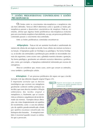 79
                                                              Fisiopatologia do Câncer
Capítulo 2



7 - LESÕES PROLIFERATIVAS CONTROLADAS E LESÕES
PRÉ-NEOPLÁSICAS


        Os limites entre os crescimentos não-neoplásicos e neoplásicos não
são bem definidos. Torna-se difícil determinar como e quando as lesões pré-
neoplásicas passam a desenvolver características de neoplasia. Pode-se, no
entanto, afirmar que algumas lesões proliferativas não-neoplásicas evoluirão
para um crescimento neoplásico bem definido, ou seja, um processo proliferativo
controlado passará a crescimento não-controlado.
        Entre as lesões proliferativas controladas encontram-se:


             Hiperplasia - Trata-se de um aumento localizado e autolimitado do
número de células de um órgão ou tecido. Essas células são normais na forma e
na função. A hiperplasia pode ser fisiológica ou patológica. Na forma fisiológi-
ca, os tecidos são estimulados à proliferação para atender às necessidades nor-
mais do organismo, como ocorre com a glândula mamária durante a gestação.
Na forma patológica, geralmente um estímulo excessivo determina a prolifera-
ção, como, por exemplo, a hiperplasia endometrial estimulada por excesso de
estrogênios.
        Deve-se considerar que, nesses casos, assim que cessam os estímulos,
cessa também a proliferação celular.


         Metaplasia - É um processo proliferativo de reparo em que o tecido
formado é de tipo diferente daquele original (Figura 2.9).
É importante assinalar que os desvios
                                                      Figura 2.9 - Aspecto microscópico de metaplasia
morfológicos que ocorrem nas metaplasias                           escamosa em epitélio glandular mucoso
                                                                   endocervical. (HE X200).
geralmente conferem melhor proteção aos
tecidos; que esses desvios mantêm a filiação
embrionária dos tecidos original e
metaplásico; e, finalmente, que as caracte-
rísticas celulares e arquiteturais do tecido for-
mado são normais. Exemplos dessas altera-
ções são vistos freqüentemente em epitélios
de revestimento, como o caso da substitui-
ção do epitélio pseudo-estratificado ciliado
por epitélio escamoso estratificado nos
brônquios dos fumantes. A metaplasia tam-
bém é reversível quando cessam os estímu-           Fonte: Arquivo pessoal de Elizabeth Carvalho Alves.

los que a provocam.
 