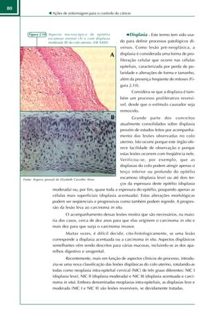 80
                          Ações de enfermagem para o controle do câncer




        Figura 2.10 - Aspecto microscópico de epitélio                    Displasia - Este termo tem sido usa-
                      escamoso normal (A) e com displasia
                      moderada (B) do colo uterino. (HE X400).       do para definir processos patológicos di-
                                                                     versos. Como lesão pré-neoplásica, a
                                                                 A   displasia é considerada uma forma de pro-
                                                                     liferação celular que ocorre nas células
                                                                     epiteliais, caracterizada por perda de po-
                                                                     laridade e alterações de forma e tamanho,
                                                                     além da presença freqüente de mitoses (Fi-
                                                                     gura 2.10).
                                                                           Considera-se que a displasia é tam-
                                                                     bém um processo proliferativo reversí-
                                                                     vel, desde que o estímulo causador seja
                                                                     removido.
                                                                 B      Grande parte dos conceitos
                                                                 atualmente consolidados sobre displasia
                                                                 provém de estudos feitos por acompanha-
                                                                 mento das lesões observadas no colo
                                                                 uterino. lsto ocorre porque este órgão ofe-
                                                                 rece facilidade de observação e porque
                                                                 estas lesões ocorrem com freqüência nele.
                                                                 Verificou-se, por exemplo, que as
                                                                 displasias do colo podem atingir apenas o
                                                                 terço inferior ou profundo do epitélio
     Fonte: Arquivo   pessoal de Elizabeth Carvalho Alves.
                                                                 escamoso (displasia leve) ou até dois ter-
                                                                 ços da espessura deste epitélio (displasia
                           moderada) ou, por fim, quase toda a espessura do epitélio, poupando apenas as
                           células mais superficiais (displasia acentuada). Estas alterações morfológicas
                           podem ser seqüenciais e progressivas como também podem regredir. A progres-
                           são da lesão leva ao carcinoma in situ.
                                  O acompanhamento dessas lesões mostra que são necessários, na maio-
                          ria dos casos, cerca de dez anos para que elas originem o carcinoma in situ e
                          mais dez para que surja o carcinoma invasor.
                                 Muitas vezes, é difícil decidir, cito-histologicamente, se uma lesão
                          corresponde a displasia acentuada ou a carcinoma in situ. Aspectos displásicos
                          semelhantes vêm sendo descritos para várias mucosas, incluindo-se as dos apa-
                          relhos digestivo e urogenital.
                                  Recentemente, mais em função de aspectos clínicos do processo, introdu-
                          ziu-se uma nova classificação das lesões displásicas do colo uterino, rotulando-as
                          todas como neoplasia intra-epitelial cervical (NIC) de três graus diferentes: NIC I
                          (displasia leve), NIC II (displasia moderada) e NIC III (displasia acentuada e carci-
                          noma in situ). Embora denominadas neoplasias intra-epiteliais, as displasias leve e
                          moderada (NIC I e NIC II) são lesões reversíveis, se devidamente tratadas.
 