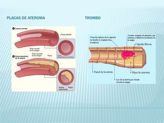 PLACAS DE ATEROMA TROMBO
 