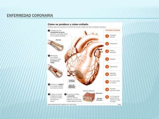 ENFERMEDAD CORONARIA
 