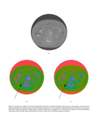 (a)
(b) (c)
Figure 8: Examples of a single CT slice (note that printed colours do not match exactly the colours shown on the monitor): (a) the slice dis-
playedusinga greyscaleintensity ramp; (b) colours from the original seven-colourexperiment,although the locationand bordersof eachregion
are clearly visible, the makeup of certain regions is difficult to determine, compared to; (c) colours from the final seven-colour experiment,
which show clearly that the region referenced by the arrow is made up of two different groups of elements
 