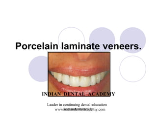 Porcelain laminate veneers.
INDIAN DENTAL ACADEMY
Leader in continuing dental education
www.indiandentalacademy.comwww.indiandentalacademy.com
 