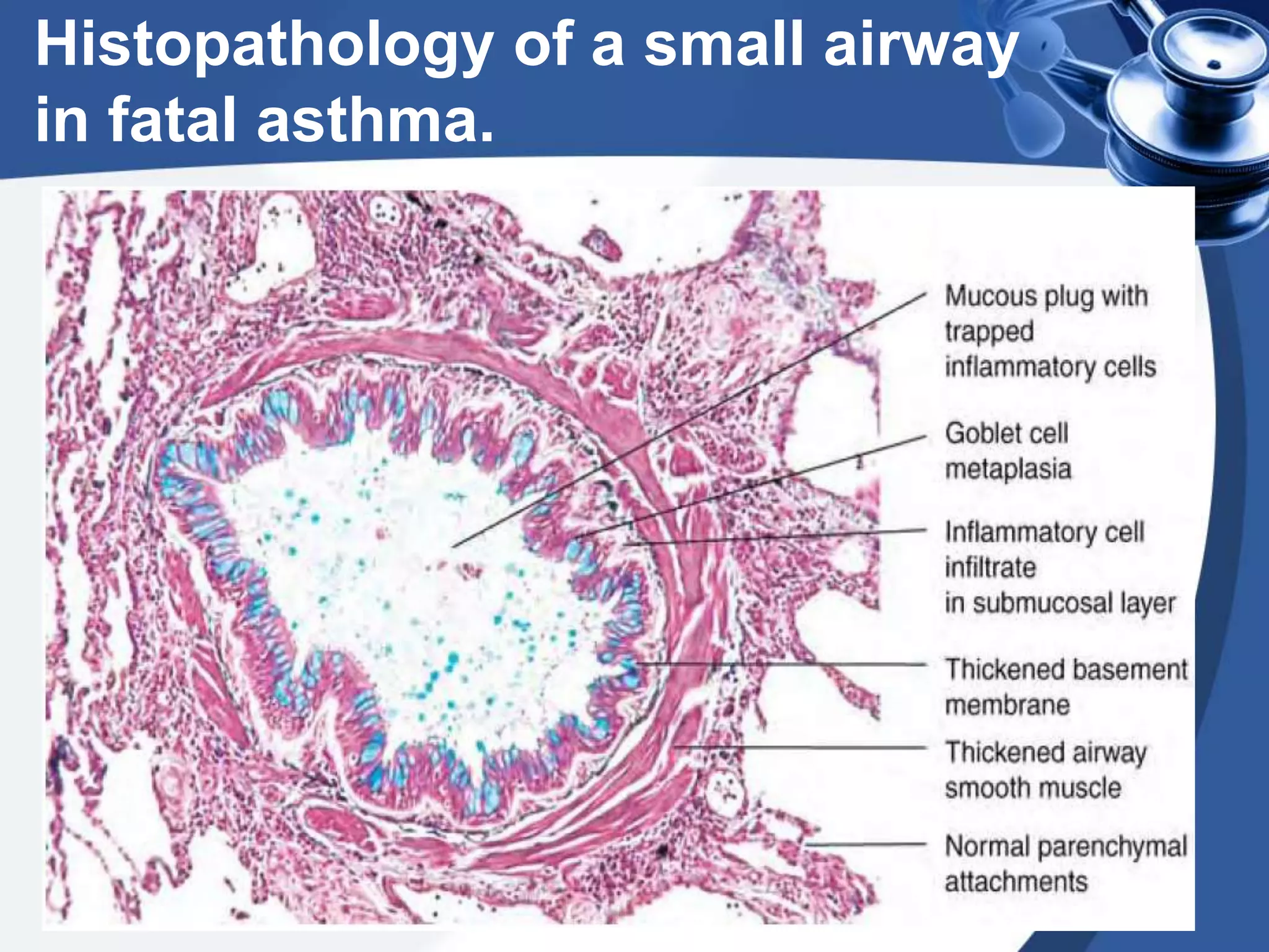Histopathology of a small airway
in fatal asthma.
 
