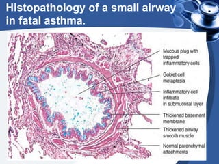 Histopathology of a small airway
in fatal asthma.
 