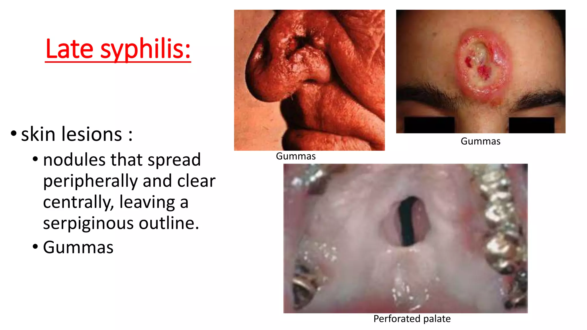 10th-lecture-syphilis-pptx