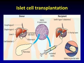 Islet cell transplantation
 