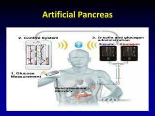 Artificial Pancreas
 