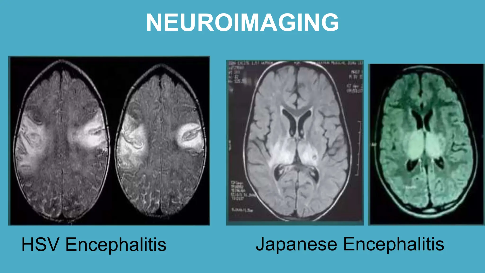 acute encephalitis syndrome | PPTX