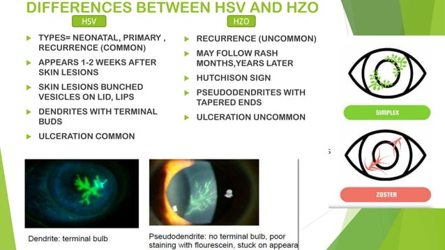 Viral Keratitis.pdf
