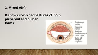 Comprehensive Overview of Vernal Keratoconjunctivitis: Pathogenesis ...