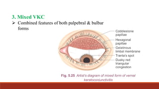 Vernal Keratoconjunctivitis (VKC) & Trachoma- Clinical Features ...