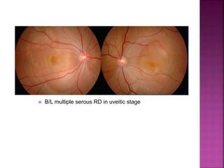  B/L multiple serous RD in uveitic stage
 