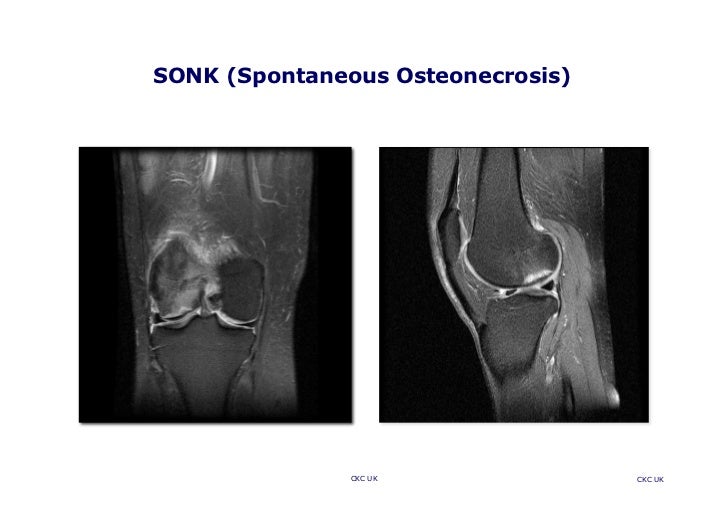 Subchondral Events And Treatment