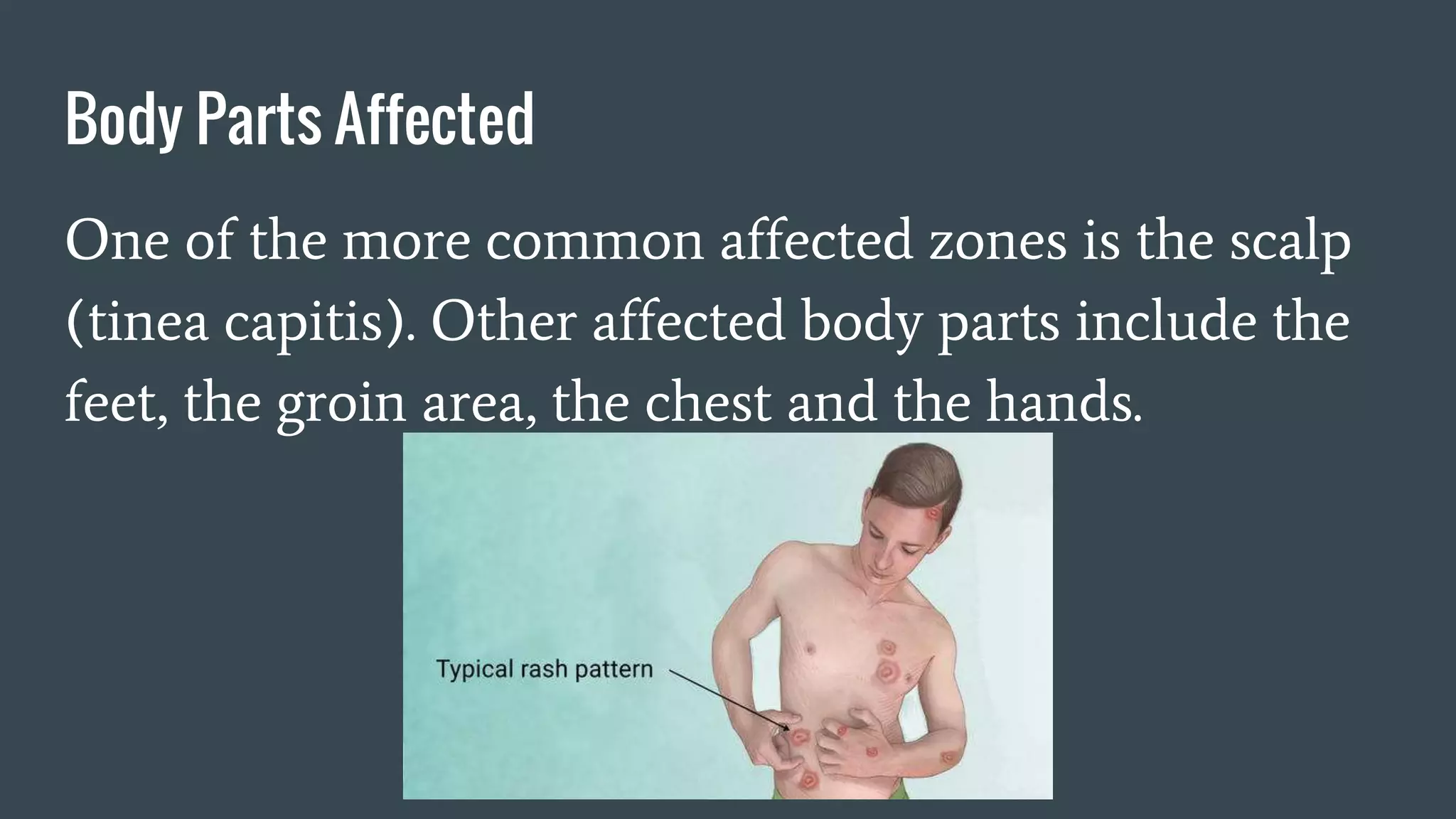 Body Parts Affected
One of the more common affected zones is the scalp
(tinea capitis). Other affected body parts include the
feet, the groin area, the chest and the hands.
 