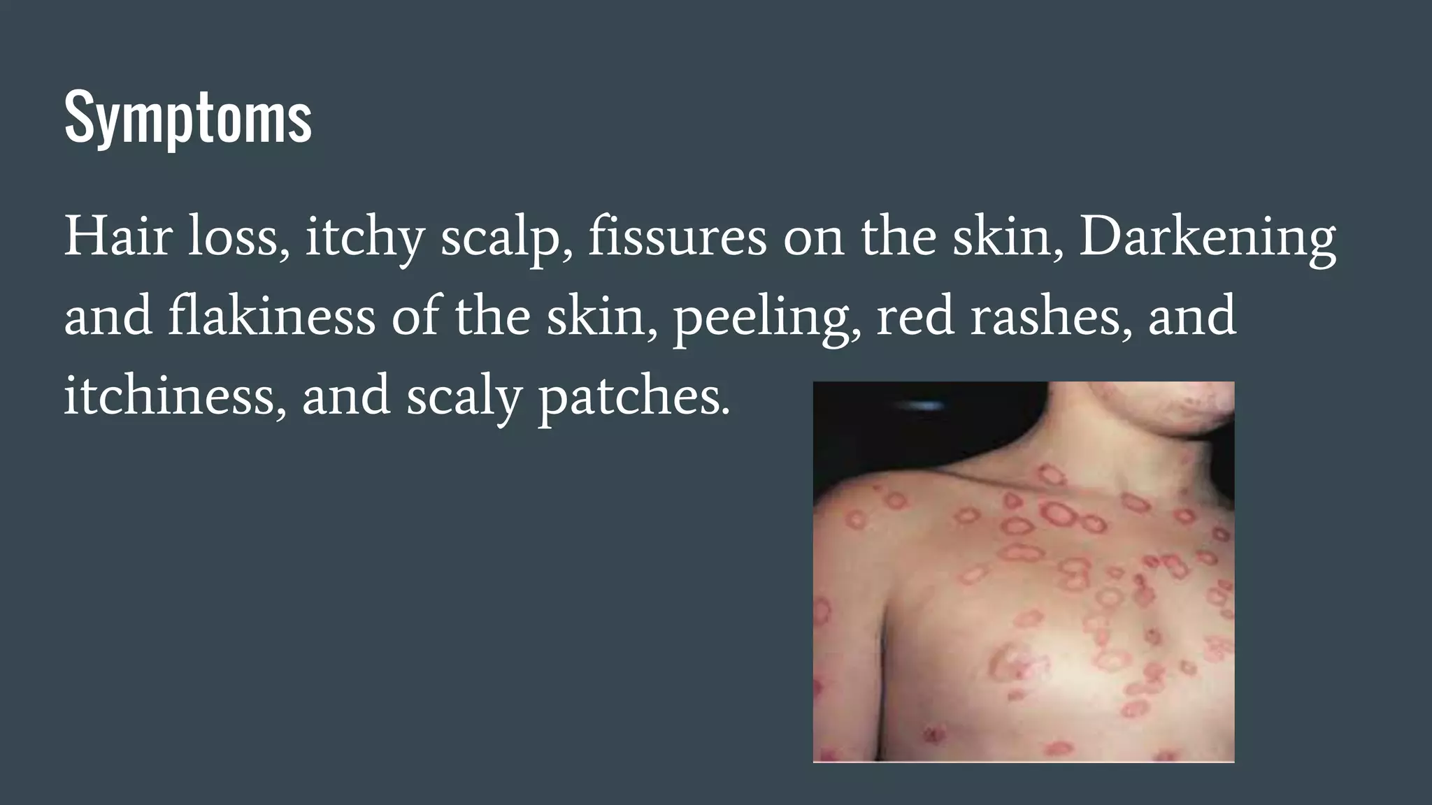 Symptoms
Hair loss, itchy scalp, fissures on the skin, Darkening
and flakiness of the skin, peeling, red rashes, and
itchiness, and scaly patches.
 