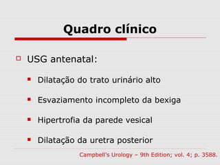 Quadro clínico
 USG antenatal:
 Dilatação do trato urinário alto
 Esvaziamento incompleto da bexiga
 Hipertrofia da parede vesical
 Dilatação da uretra posterior
Campbell’s Urology – 9th Edition; vol. 4; p. 3588.
 