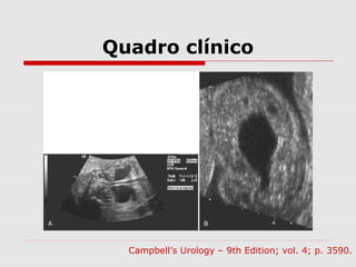 Quadro clínico
Campbell’s Urology – 9th Edition; vol. 4; p. 3590.
 