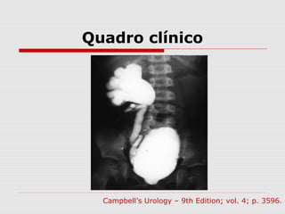 Quadro clínico
Campbell’s Urology – 9th Edition; vol. 4; p. 3596.
 