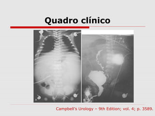 Quadro clínico
Campbell’s Urology – 9th Edition; vol. 4; p. 3589.
 