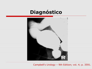Diagnóstico
Campbell’s Urology – 9th Edition; vol. 4; p. 3591.
 