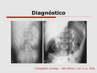 Diagnóstico
Campbell’s Urology – 9th Edition; vol. 4; p. 3591.
 