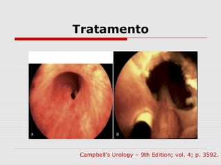 Tratamento
Campbell’s Urology – 9th Edition; vol. 4; p. 3592.
 