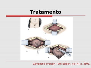 Tratamento
Campbell’s Urology – 9th Edition; vol. 4; p. 3593.
 